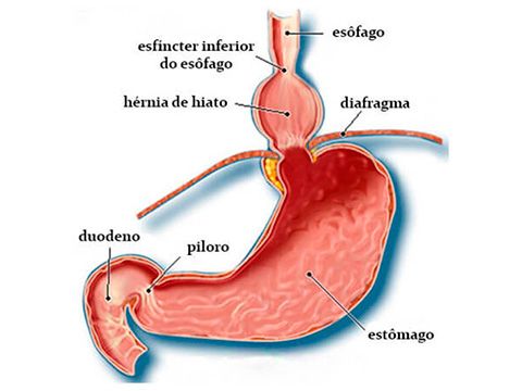 Hernia de hiato y ansiedad